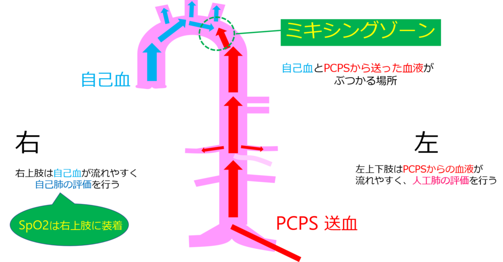 PCPS（VA‐ECMO）装着中の看護 Vol.2 ICU看護師ダンカンの心外ブログ