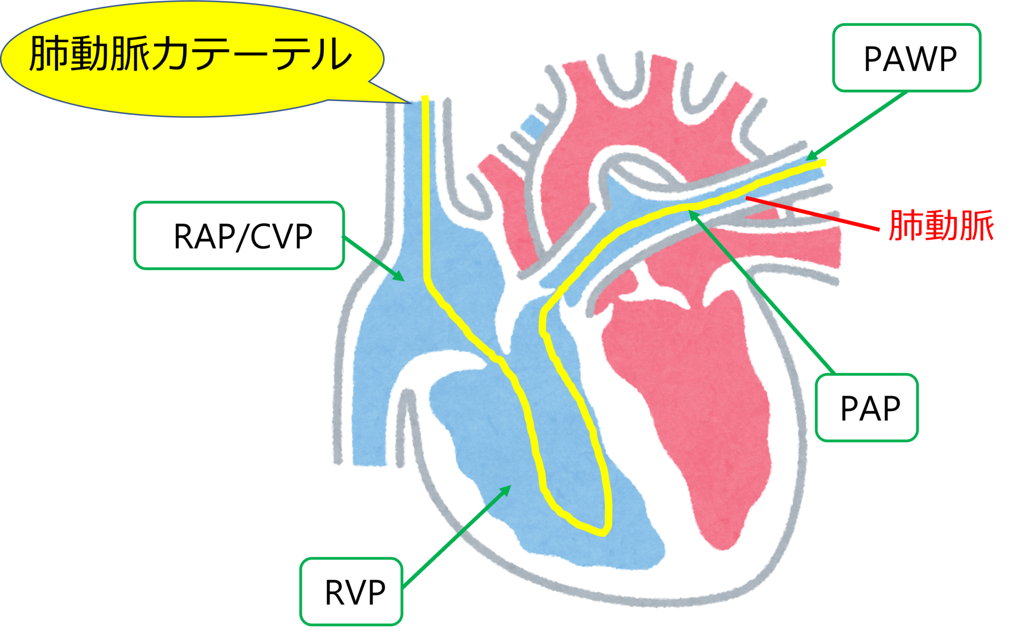 肺動脈カテーテル (PAC) とは何ですか?