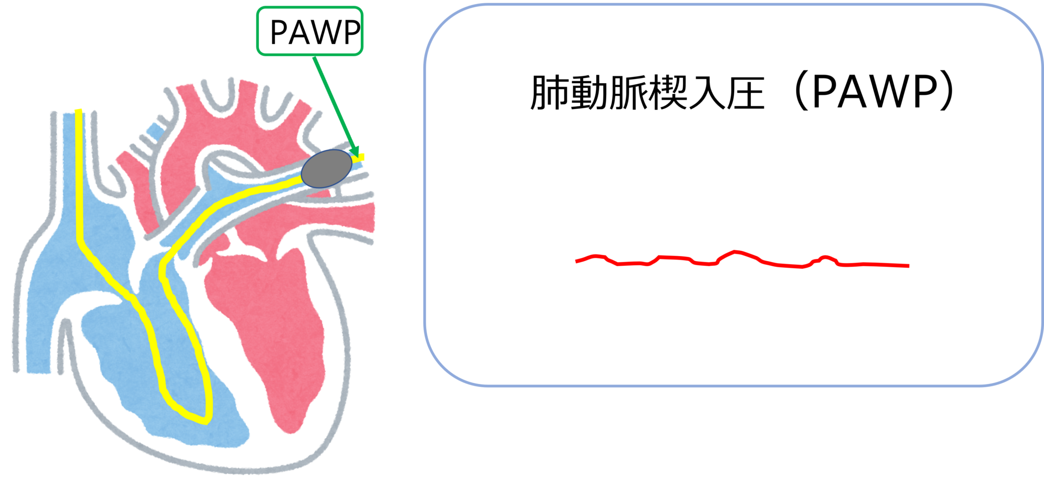 スワンガンツカテーテル挿入の準備