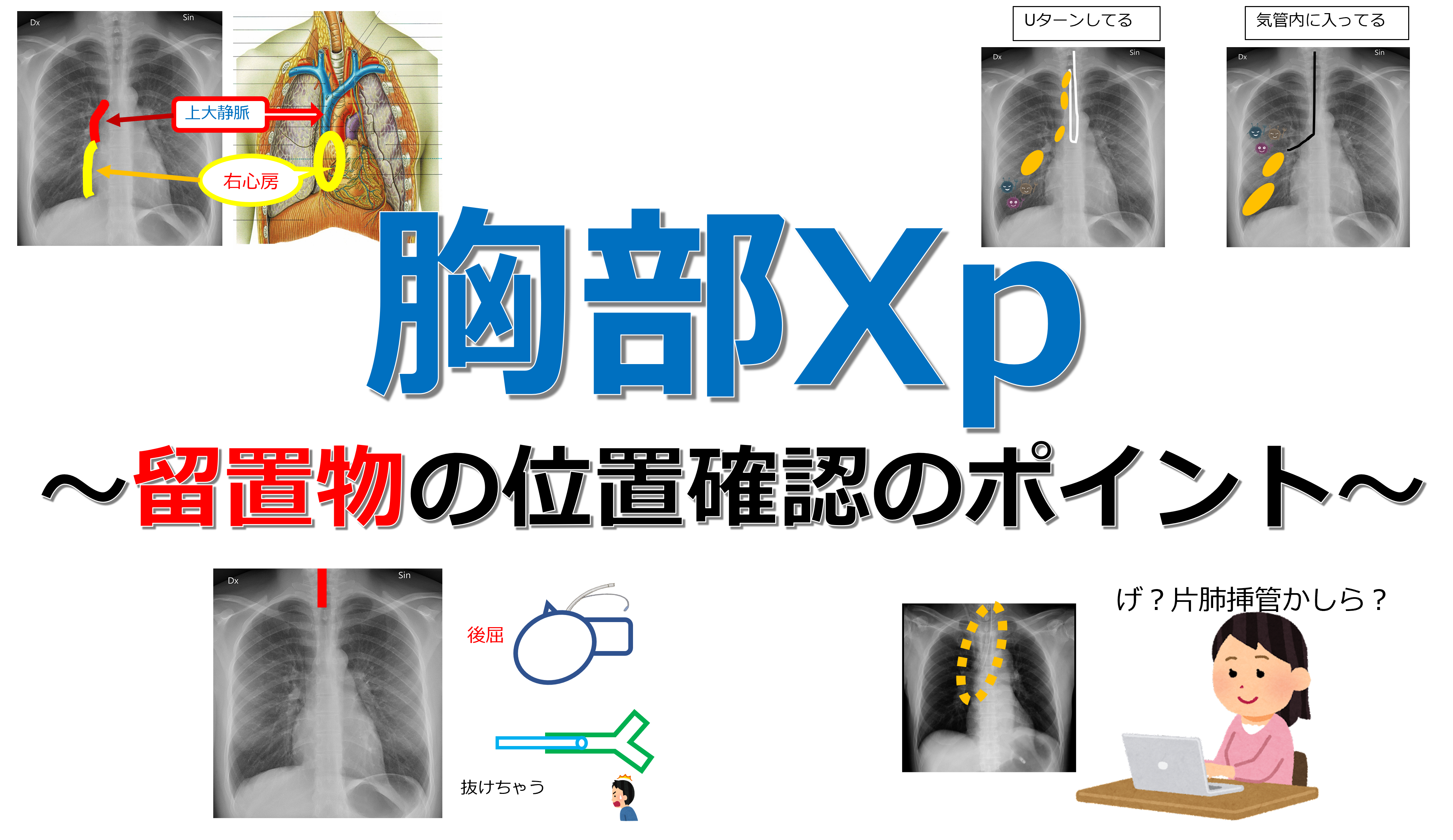 胸部Xp（レントゲン） ～留置物の位置確認のポイント ～ ①CV